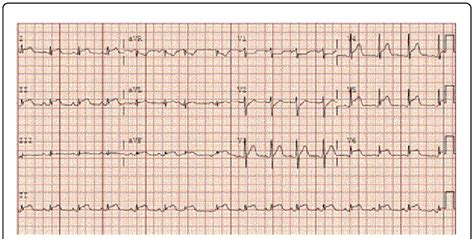 mild ventricular hypokinesis